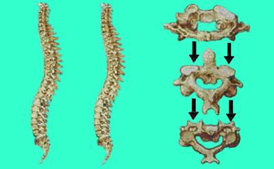 la colonne vertébrale le traumatisme médulaire peut mettre quelques années à s'installer.